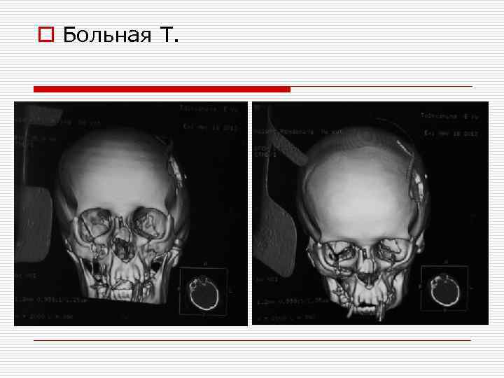 o Больная Т. 