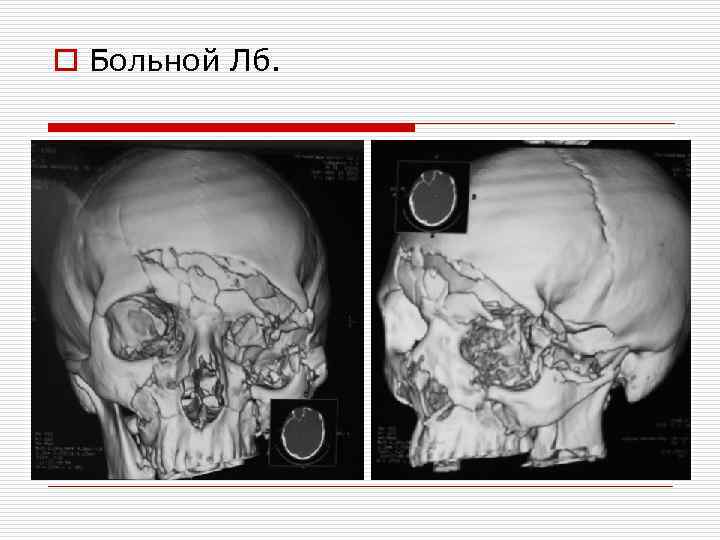 o Больной Лб. 
