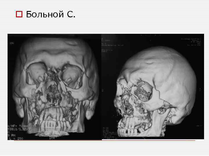 o Больной С. 