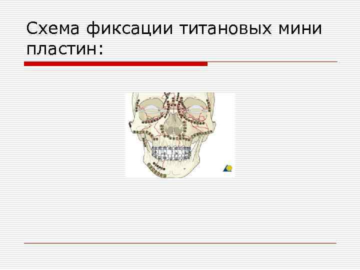 Схема фиксации титановых мини пластин: 