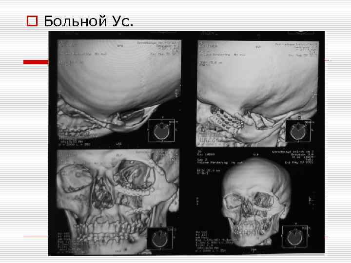 o Больной Ус. 