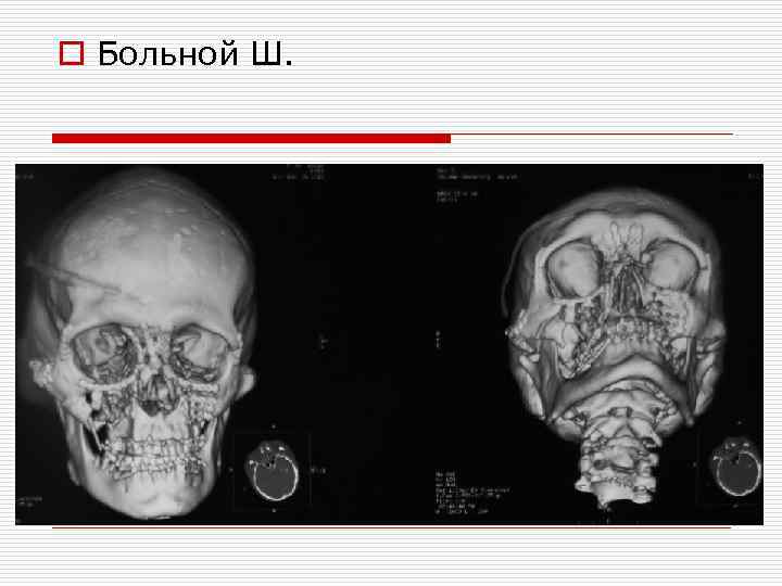 o Больной Ш. 