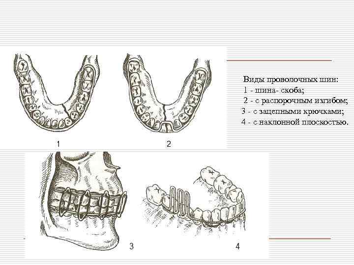 Виды проволочных шин: 1 - шина- скоба; 2 - с распорочным изгибом; 3 -