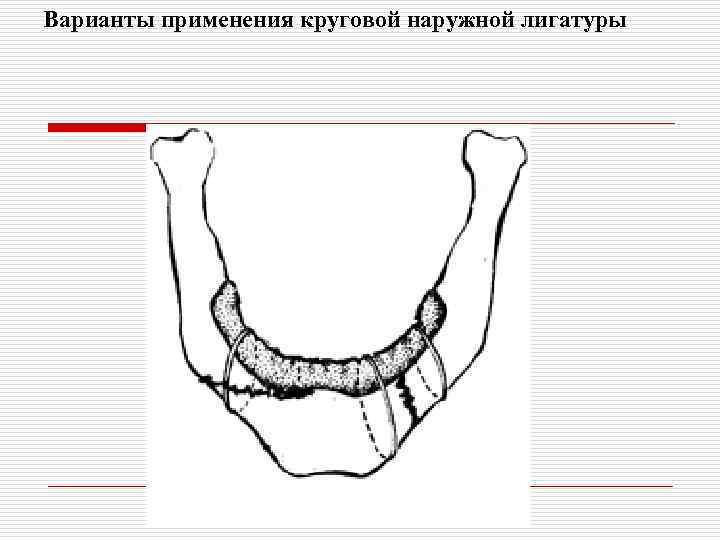 Варианты применения круговой наружной лигатуры 