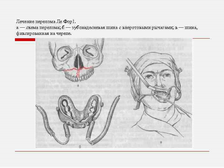 Лечение перелома Ле Фор1. а — схема перелома; б — зубонадесневая шина с внеротовыми