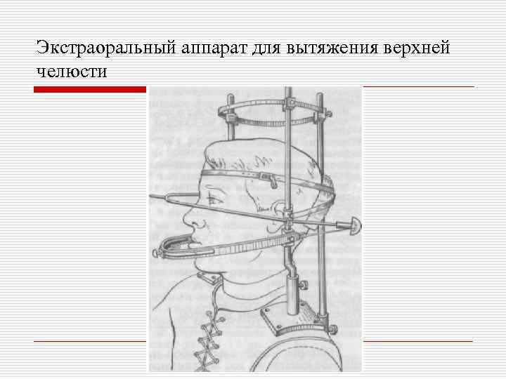 Экстраоральный аппарат для вытяжения верхней челюсти 