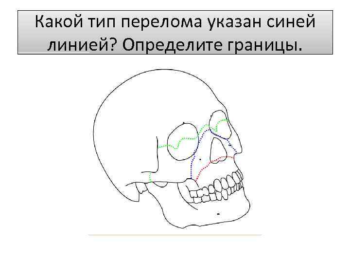 Какой тип перелома указан синей линией? Определите границы. 