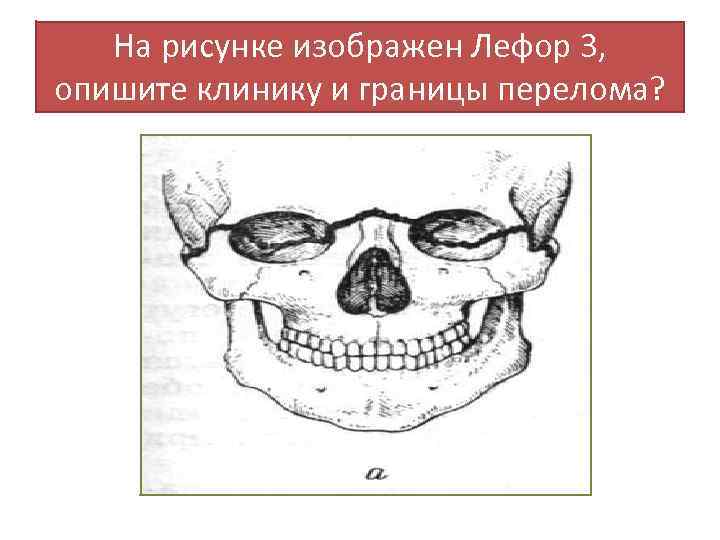 На рисунке изображен Лефор 3, опишите клинику и границы перелома? 