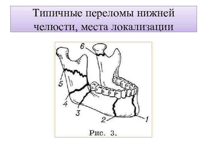 Типичные переломы нижней челюсти, места локализации 
