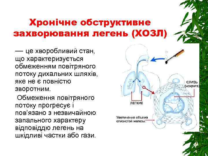 Хронічне обструктивне захворювання легень (ХОЗЛ) — це хворобливий стан, що характеризується обмеженням повітряного потоку