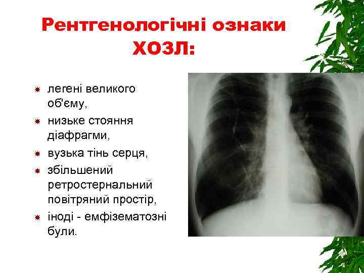 Рентгенологічні ознаки ХОЗЛ: легені великого об'єму, низьке стояння діафрагми, вузька тінь серця, збільшений ретростернальний