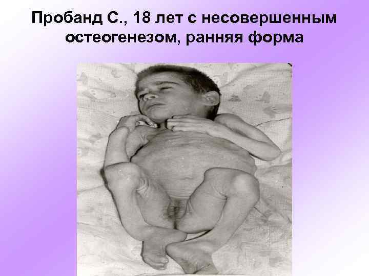 Пробанд С. , 18 лет с несовершенным остеогенезом, ранняя форма 