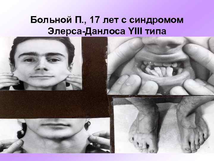 Больной П. , 17 лет с синдромом Элерса-Данлоса YIII типа 