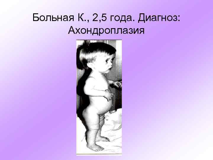 Больная К. , 2, 5 года. Диагноз: Ахондроплазия 