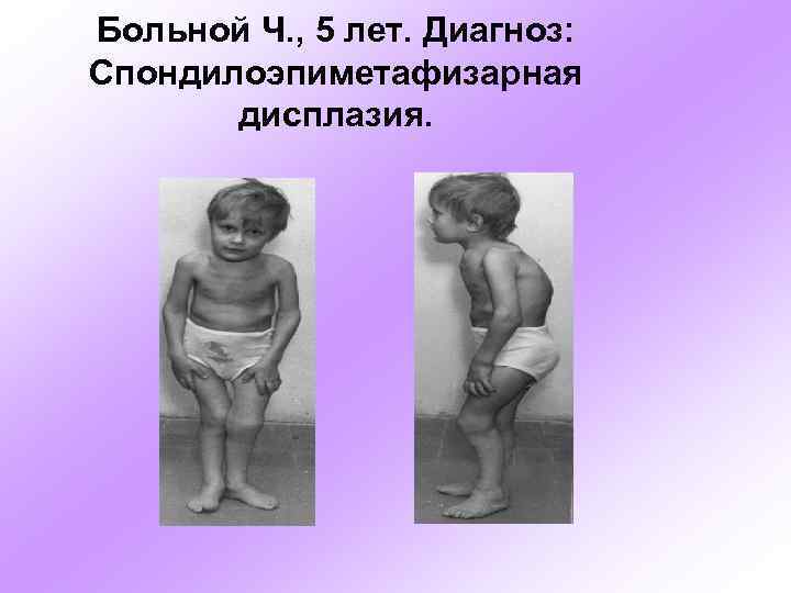 Больной Ч. , 5 лет. Диагноз: Спондилоэпиметафизарная дисплазия. 