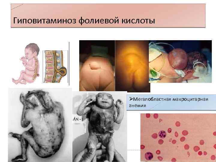 Гиповитаминоз фолиевой кислоты ØМегалобластная макроцитарная анемия 