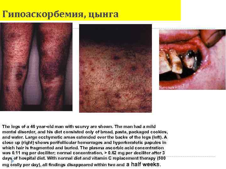 Гипоаскорбемия, цынга The legs of a 46 year-old man with scurvy are shown. The