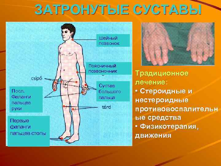 ЗАТРОНУТЫЕ СУСТАВЫ Шейный позвонок Поясничный позвоночник Посл. Фаланги пальцев руки Первые фаланги пальцев стопы