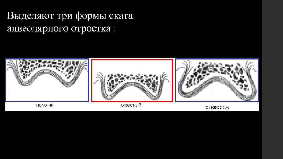 Выделяют три формы ската алвеолярного отростка : 