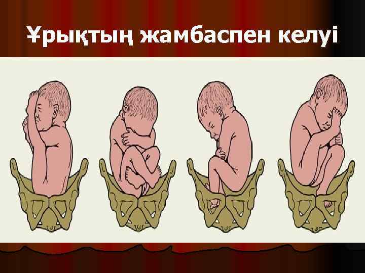 Ұрықтың жамбаспен келуі 