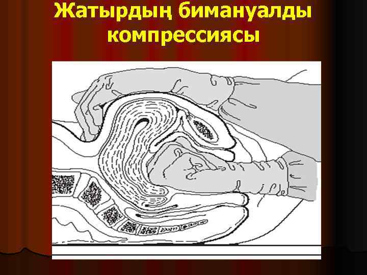 Жатырдың бимануалды компрессиясы 