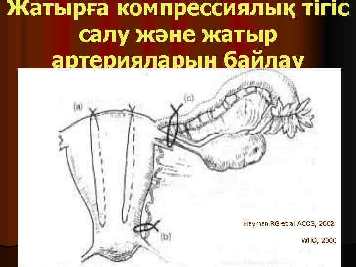 Жатырға компрессиялық тігіс салу және жатыр артерияларын байлау Hayman RG et al ACOG, 2002