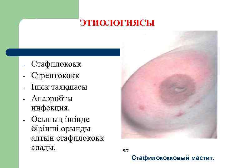 ЭТИОЛОГИЯСЫ - Стафилококк Стрептококк Ішек таяқшасы Анаэробты инфекция. Осының ішінде бірінші орынды алтын стафилококк