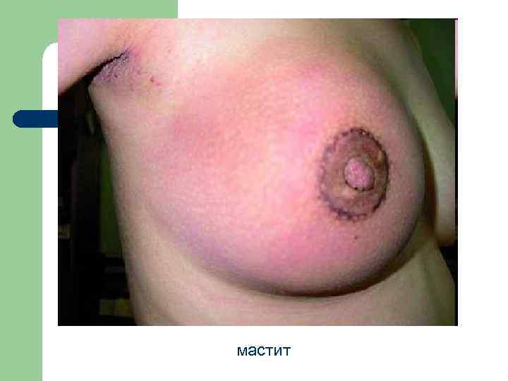 мастит 