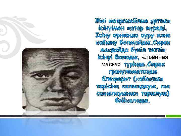 Жиі макрохейлия ұрттың ісінуімен қатар жүреді. Ісіну орнында ауру және қабыну болмайды. Сирек жағдайда