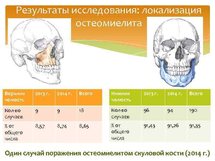 Результаты исследования: локализация остеомиелита Верхняя челюсть 2013 г. 2014 г. Всего Нижняя челюсть 2013