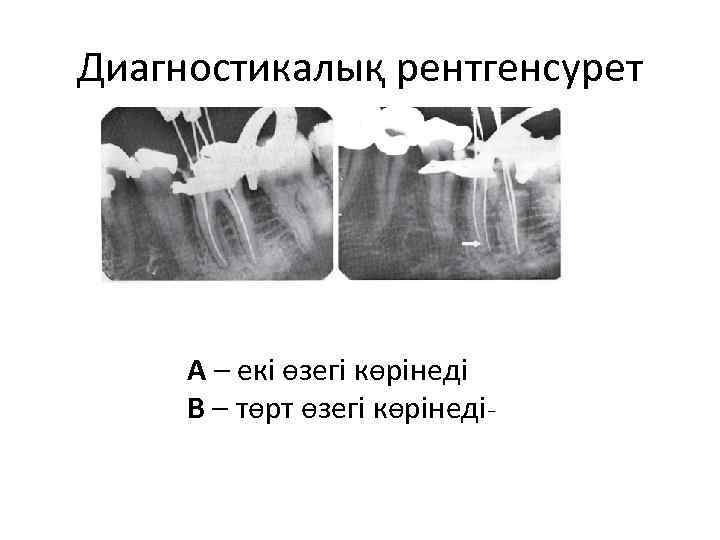 Диагностикалық рентгенсурет А – екі өзегі көрінеді В – төрт өзегі көрінедіｰ 