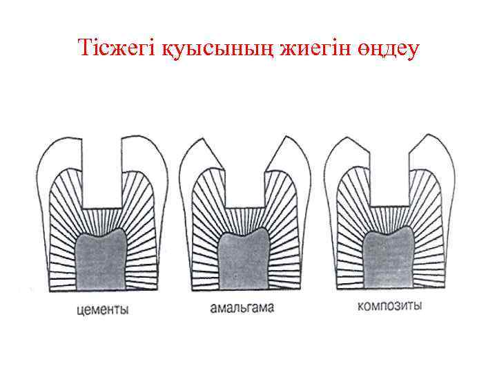 Тісжегі қуысының жиегін өңдеу 