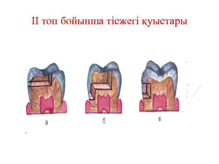 II топ бойынша тісжегі қуыстары 