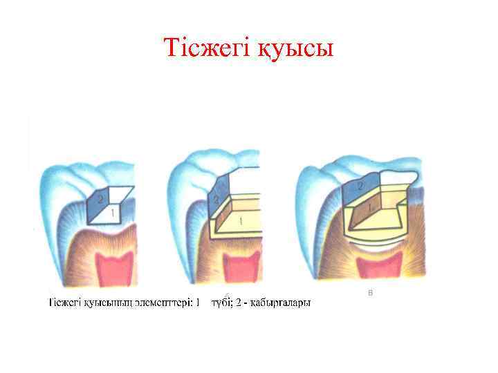 Тісжегі қуысы 