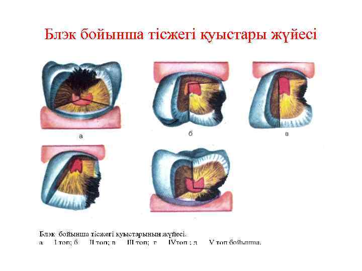 Блэк бойынша тісжегі қуыстары жүйесі 