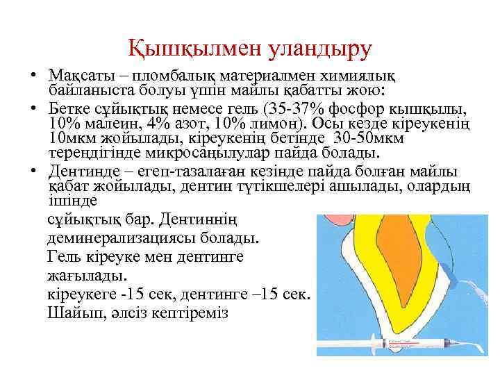 Қышқылмен уландыру • Мақсаты – пломбалық материалмен химиялық байланыста болуы үшін майлы қабатты жою: