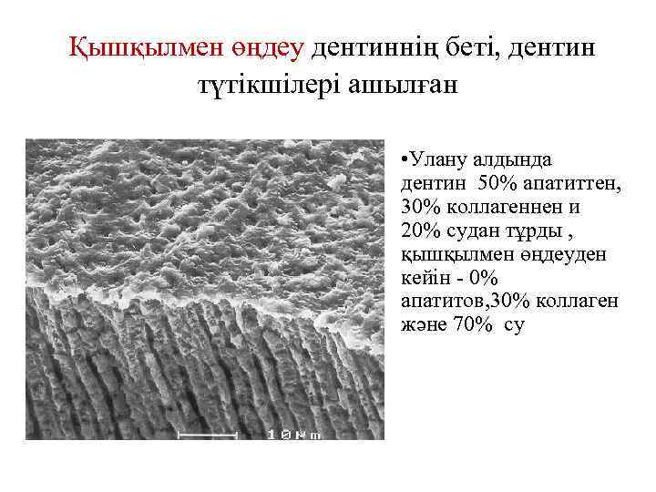 Қышқылмен өңдеу дентиннің беті, дентин түтікшілері ашылған • Улану алдында дентин 50% апатиттен, 30%