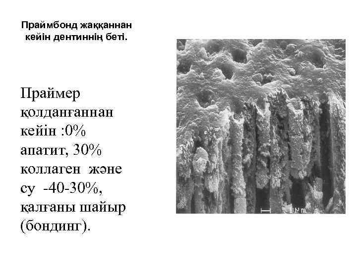 Праймбонд жаққаннан кейін дентиннің беті. Праймер қолданғаннан кейін : 0% апатит, 30% коллаген және