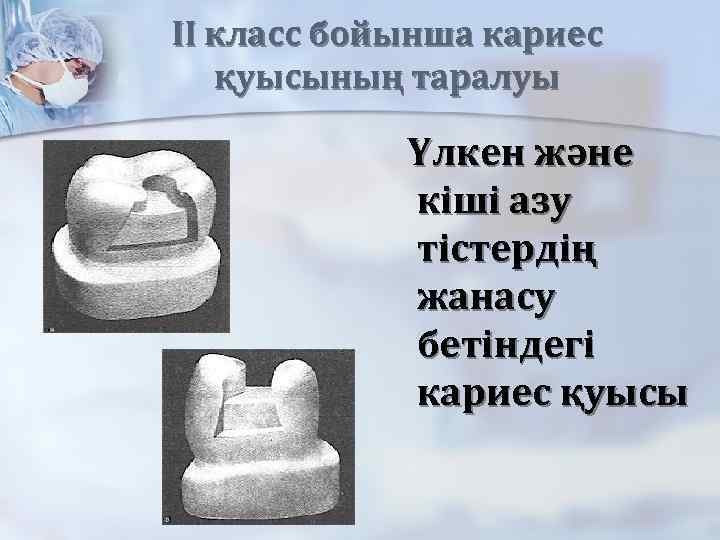 II класс бойынша кариес қуысының таралуы Үлкен және кіші азу тістердің жанасу бетіндегі кариес