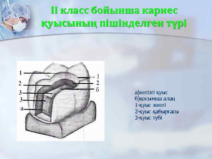 II класс бойынша кариес қуысының пішінделген түрі а)негізгі қуыс б)қосымша алаң 1 -қуыс жиегі