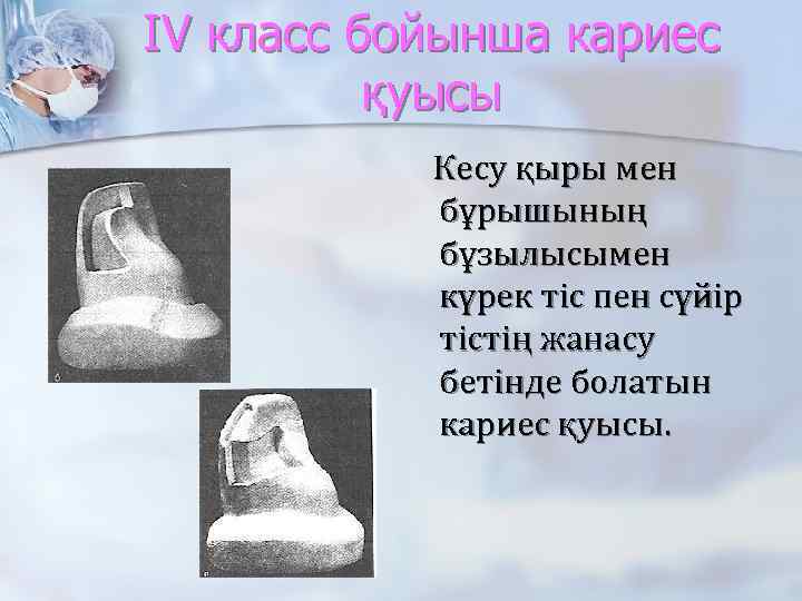 IV класс бойынша кариес қуысы Кесу қыры мен бұрышының бұзылысымен күрек тіс пен сүйір