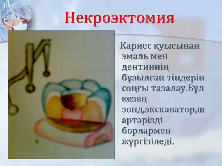 Некроэктомия Кариес қуысынан эмаль мен дентиннің бұзылған тіндерін соңғы тазалау. Бұл кезең зонд, экскаватор,