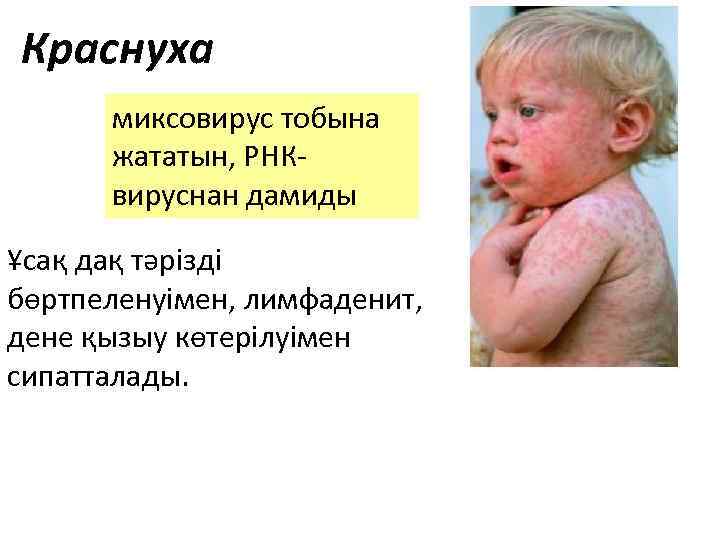 Краснуха миксовирус тобына жататын, РНКвируснан дамиды Ұсақ дақ тәрізді бөртпеленуімен, лимфаденит, дене қызыу көтерілуімен
