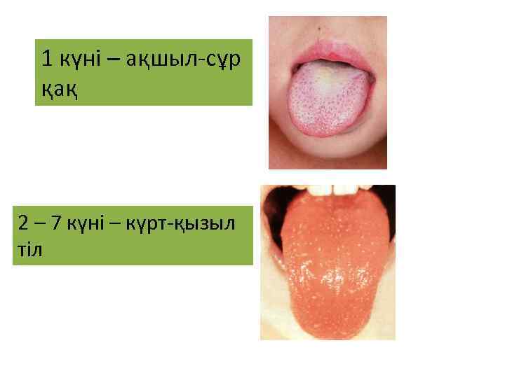 1 күні – ақшыл-сұр қақ 2 – 7 күні – күрт-қызыл тіл 
