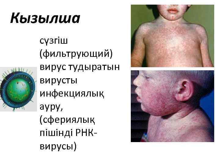 Кызылша сүзгіш (фильтрующий) вирус тудыратын вирусты инфекциялық ауру, (сфериялық пішінді РНКвирусы) 