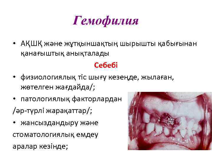 Гемофилия • АҚШҚ және жұтқыншақтың шырышты қабығынан қанағыштық анықталады Себебі • физиологиялық тіс шығу