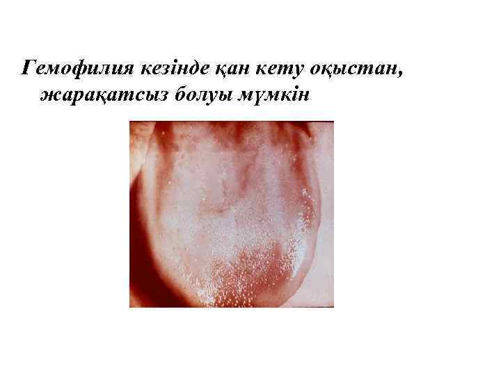 Гемофилия кезінде қан кету оқыстан, жарақатсыз болуы мүмкін 