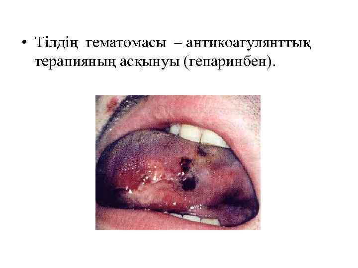  • Тілдің гематомасы – антикоагулянттық терапияның асқынуы (гепаринбен). 