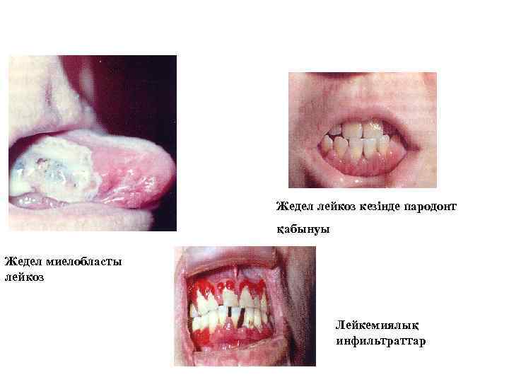 Жедел лейкоз кезінде пародонт қабынуы Жедел миелобласты лейкоз Лейкемиялық инфильтраттар 