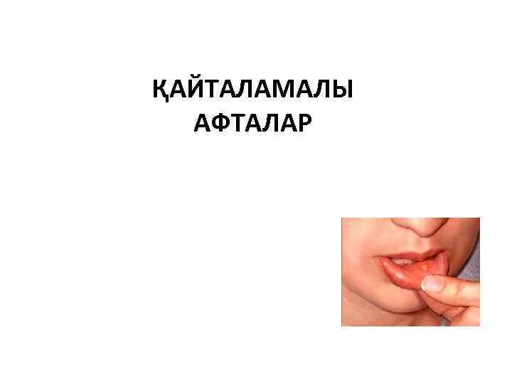 Стоматит ҚАЙТАЛАМАЛЫ АФТАЛАР 